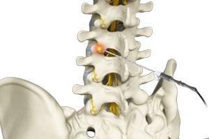 Radiofrequency Ablation for Lumbar Spondylosis pic