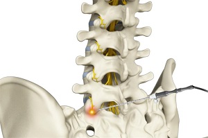 Sacroiliac Joint Radiofrequency Ablation pic