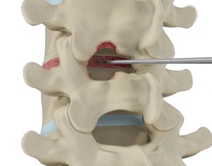 Spinal Decompression pic