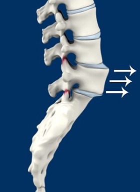 Spinal Instability pic