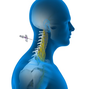 Spinal Nerve Blocks pic