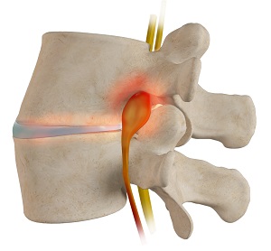 Spinal Stenosis pic