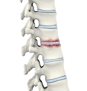 Spine Arthritis pic