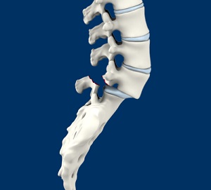 Spondylolisthesis pic