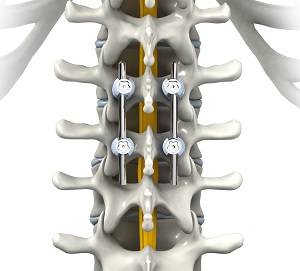 Thoracic Spine Fusion pic