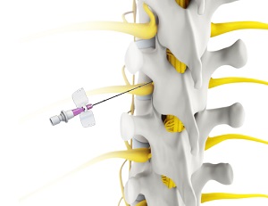 Transforaminal Epidural Steroid Injection pic