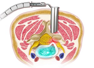 Tubular Microdiscectomy pic