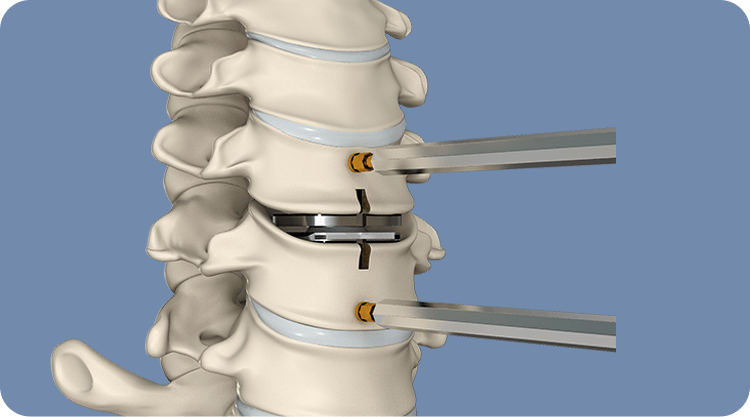 Artificial Disc Replacement Icon
