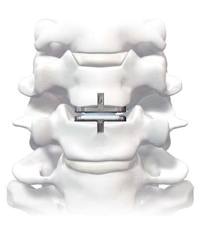 Motion-Preserving Spine Surgery