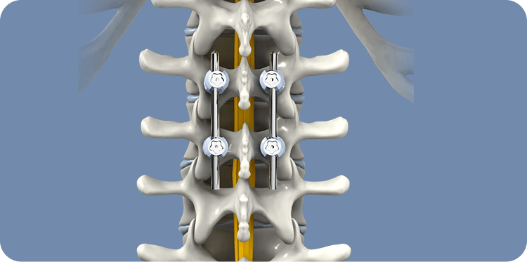 Spinal Fusion Icon