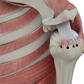 Rotator Cuff Repair img