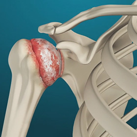 Shoulder Arthritis img