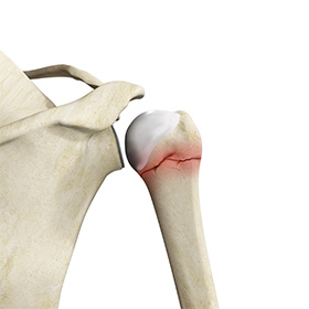 Shoulder Fracture img