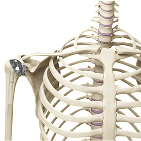 Shoulder Joint Replacement img