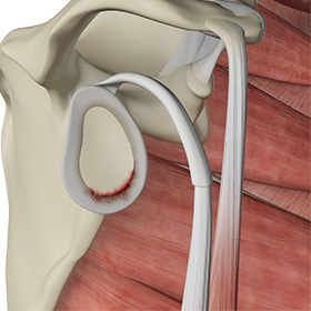Shoulder Labral Tear img
