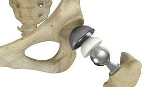 Complex Primary Hip Replacement