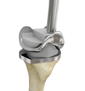 Complex Primary Knee Replacement
