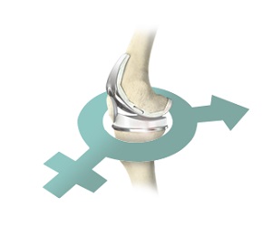 Gender-Specific Knee Replacement