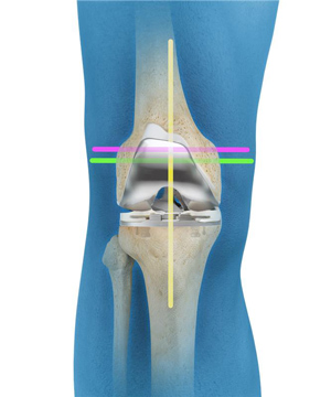 Kinematic Alignment (TKA)