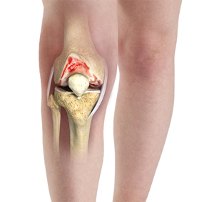 Knee Osteoarthritis Treatment