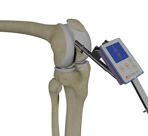 Knee Replacement with OrthAlign Technology
