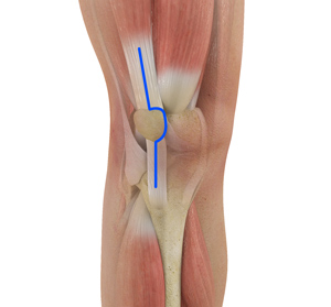 Muscle Sparing Total Knee Replacement