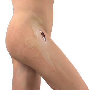 Outpatient Anterior Approach Hip Replacement