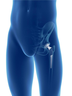 Primary Hip Replacement