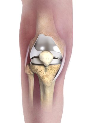 Primary Knee Replacement