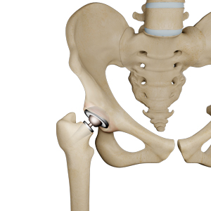 Silent Hip Implant