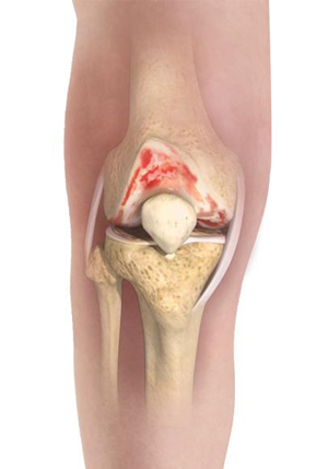 Smart Knee  Implant (Persona IQ®)