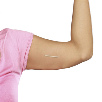 Picture of Birth Control Implant