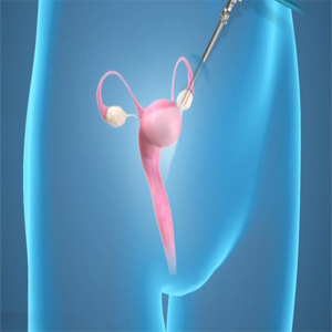 Picture of Laparoscopic Gynecologic Surgery