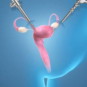 Picture of Minimally Invasive Gynecologic Surgery