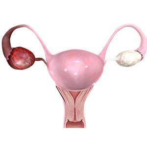 Picture of Ovarian Cysts