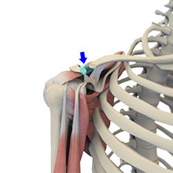 Picture of AC Joint Arthroplasty