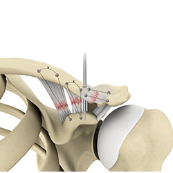 Picture of AC Joint Repair