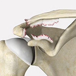 Picture of AC Joint Separation