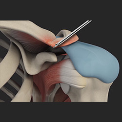 Picture of AC Joint Stabilization