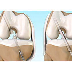 Picture of ACL Reconstruction Procedure with Hamstring Tendon