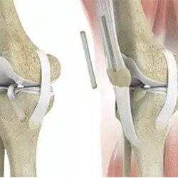 Picture of ACL Reconstruction with Quadriceps Allograft