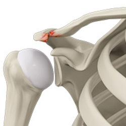 Picture of Acromioclavicular Arthritis