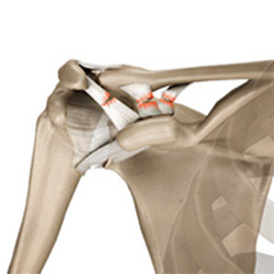 Picture of Acromioclavicular Joint Dislocation