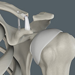 Picture of Acromioclavicular (AC) Joint Reconstruction