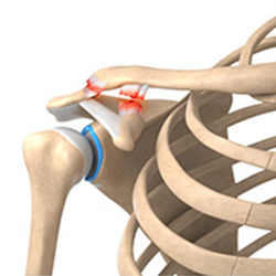 Picture of Acromioclavicular Joint Sprain