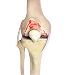 Picture of Arthritis