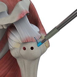 Picture of Arthroscopic Surgery