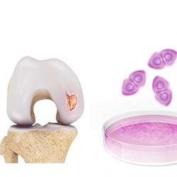 Picture of AutoCart Cartilage Restoration