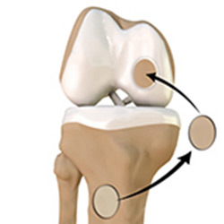 Picture of Autologous Chondrocyte Implantation