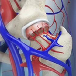 Picture of Avascular Necrosis